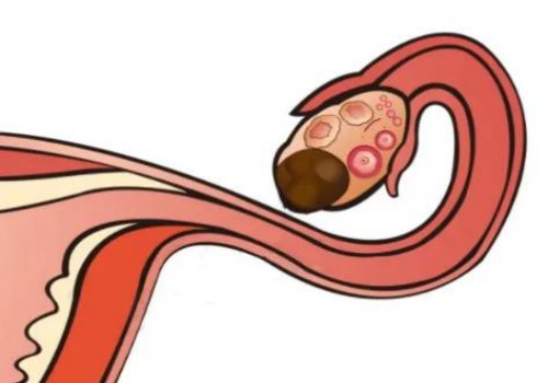宫腔粘连怀孕之后会导致胎儿畸形吗？