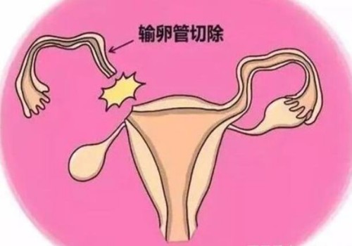 试管婴儿科普：三分钟带你了解试管婴儿如何制定方案